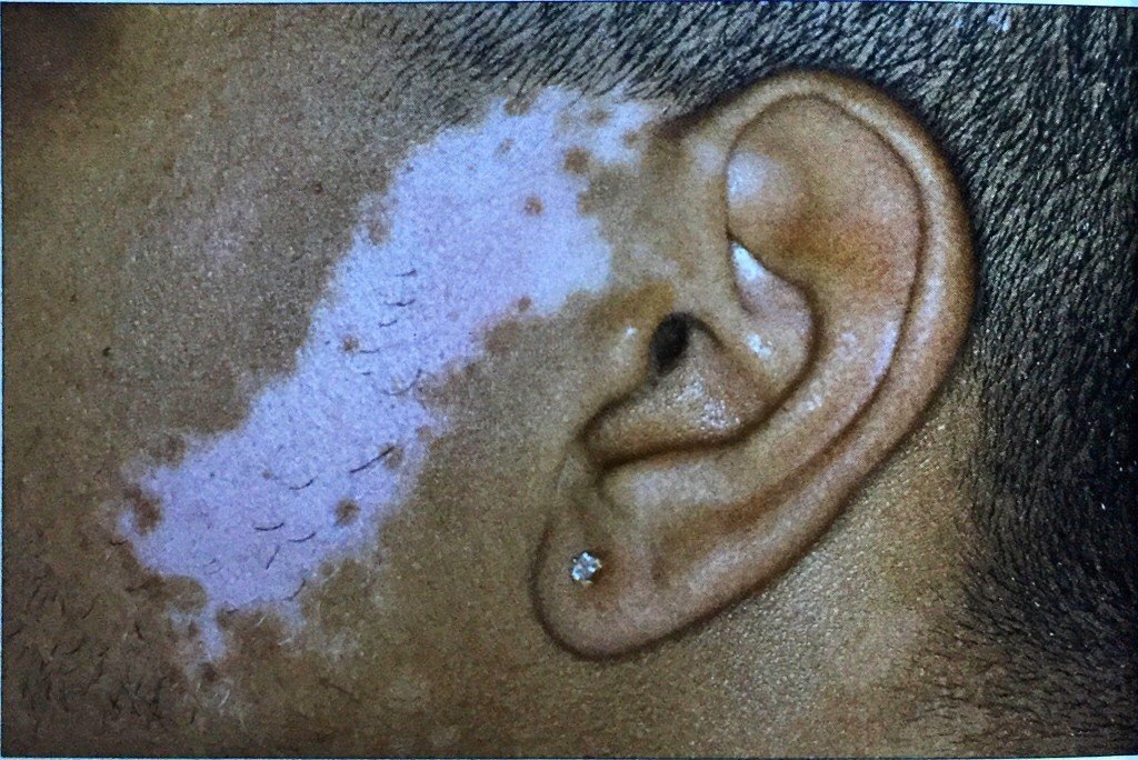 身上的这些小白点不是白癜风有可能是皮肤衰老的表现