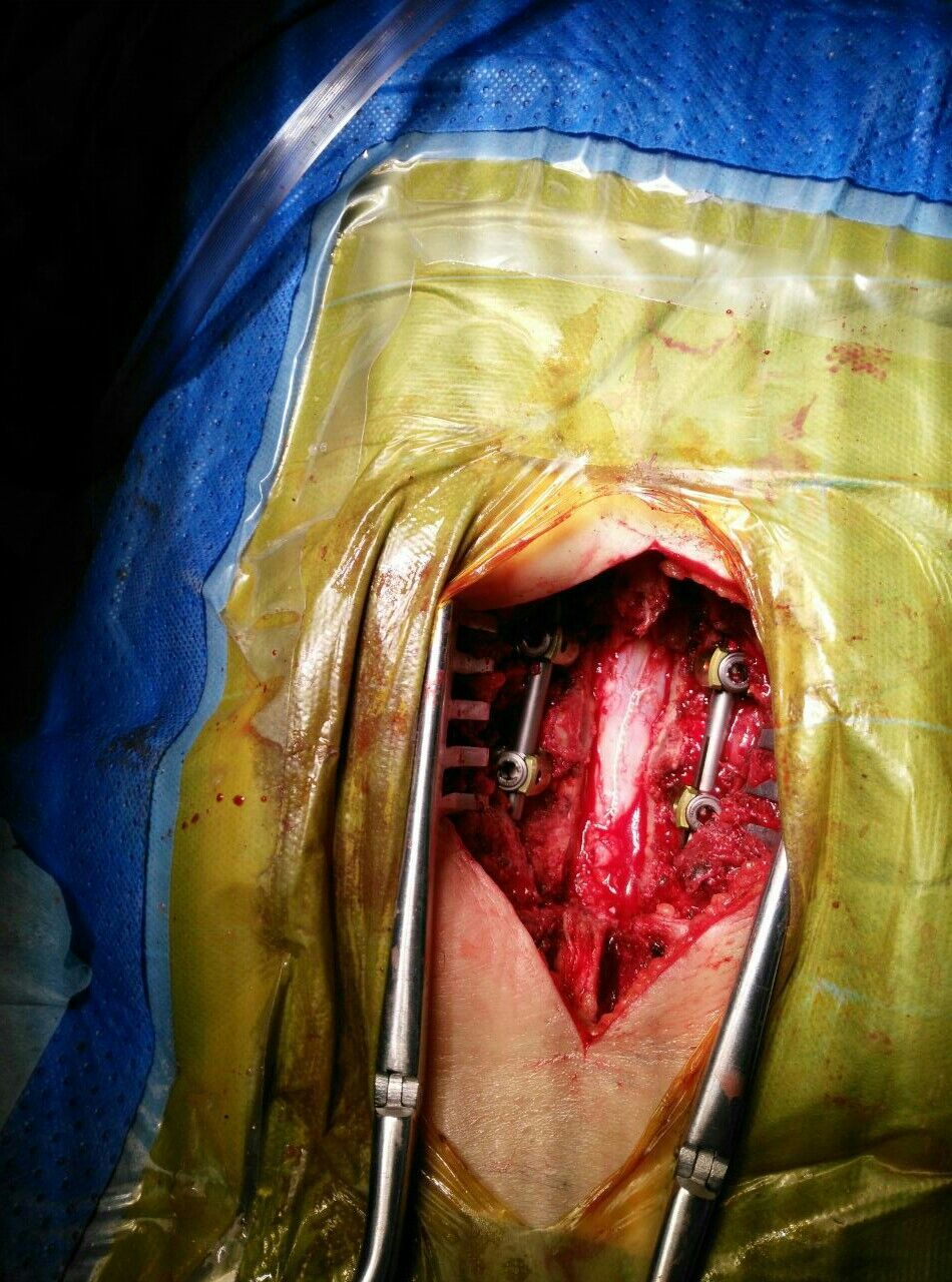 腰椎管内神经鞘瘤切除 椎弓根螺钉内固定术