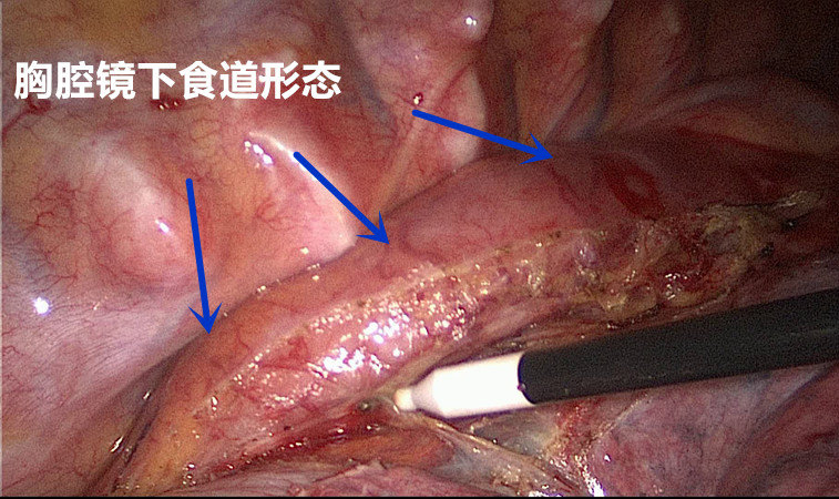 手术科普:肺癌,食管癌等胸腔镜微创手术 - 微医(挂号网)