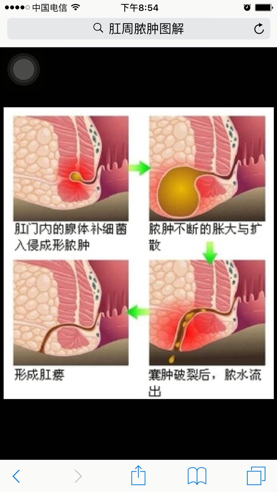 肛瘘是肛门直肠瘘的简称,是发生在肛门直肠周围的脓肿溃破或切口引流