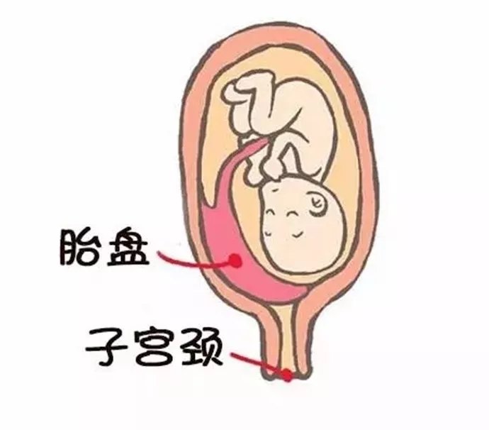 胎盘覆盖宫颈内口图片