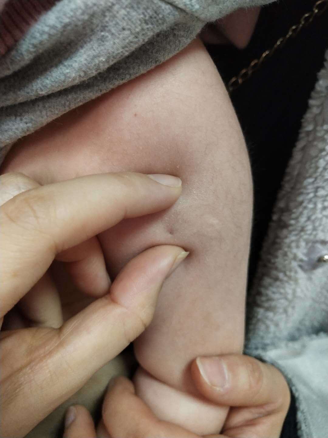 认识毛母质瘤(钙化上皮瘤) - 微医(挂号网)