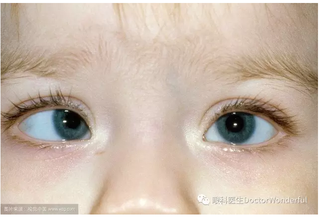 不要忽略了儿童弱视