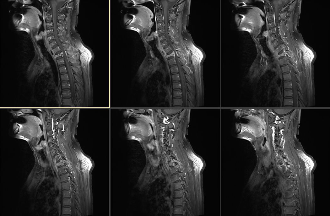 骨癌脊脊柱骨癌图片图片