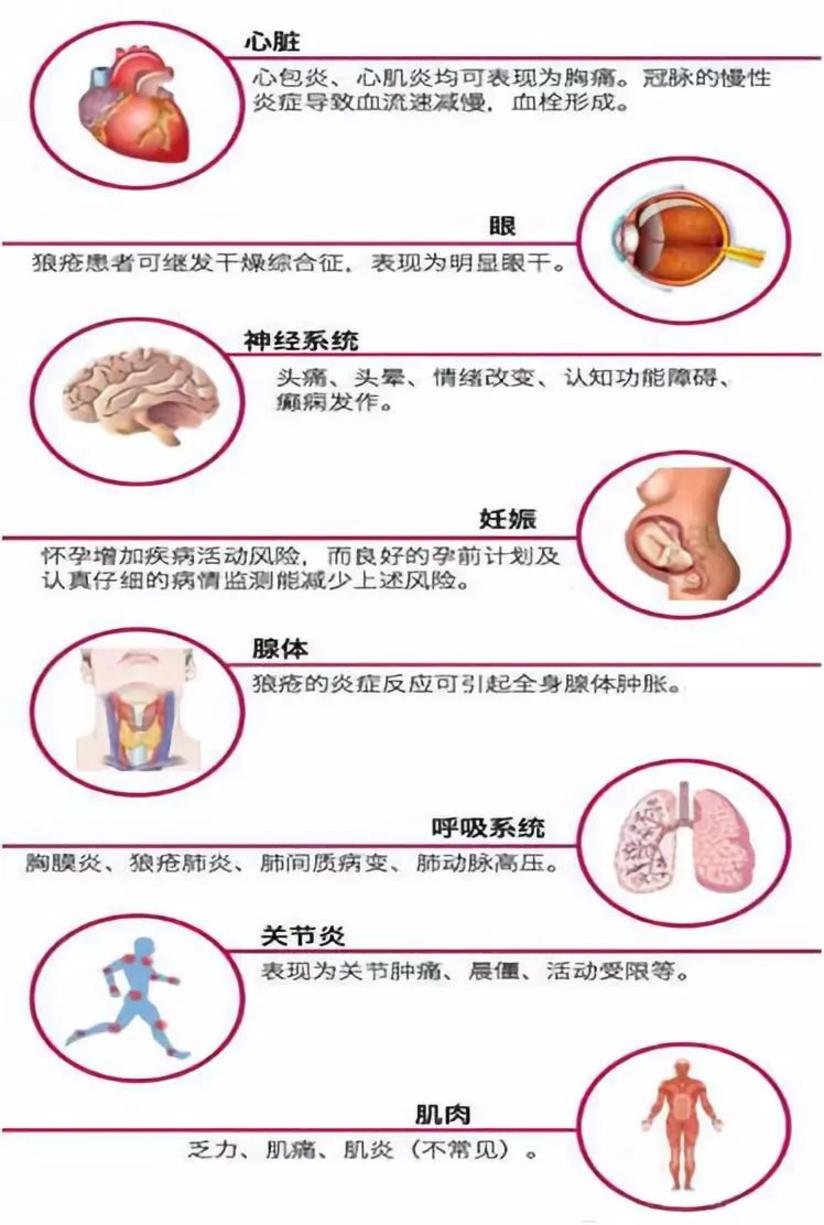 乐坛天后赛琳娜因此换肾 系统性红斑狼疮到底是种什么病 健康号 微医