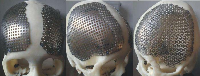 peek修补颅骨后手能摸到接逢处的缝隙吗