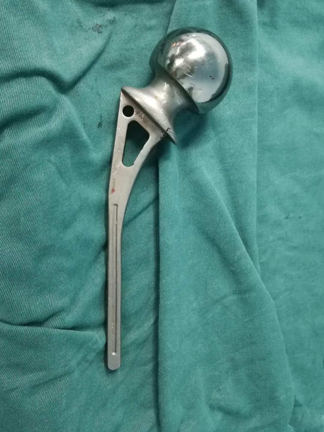 病例3 双髋关节置换术后,一侧感染,窦道流脓,第一次取出假体,旷置