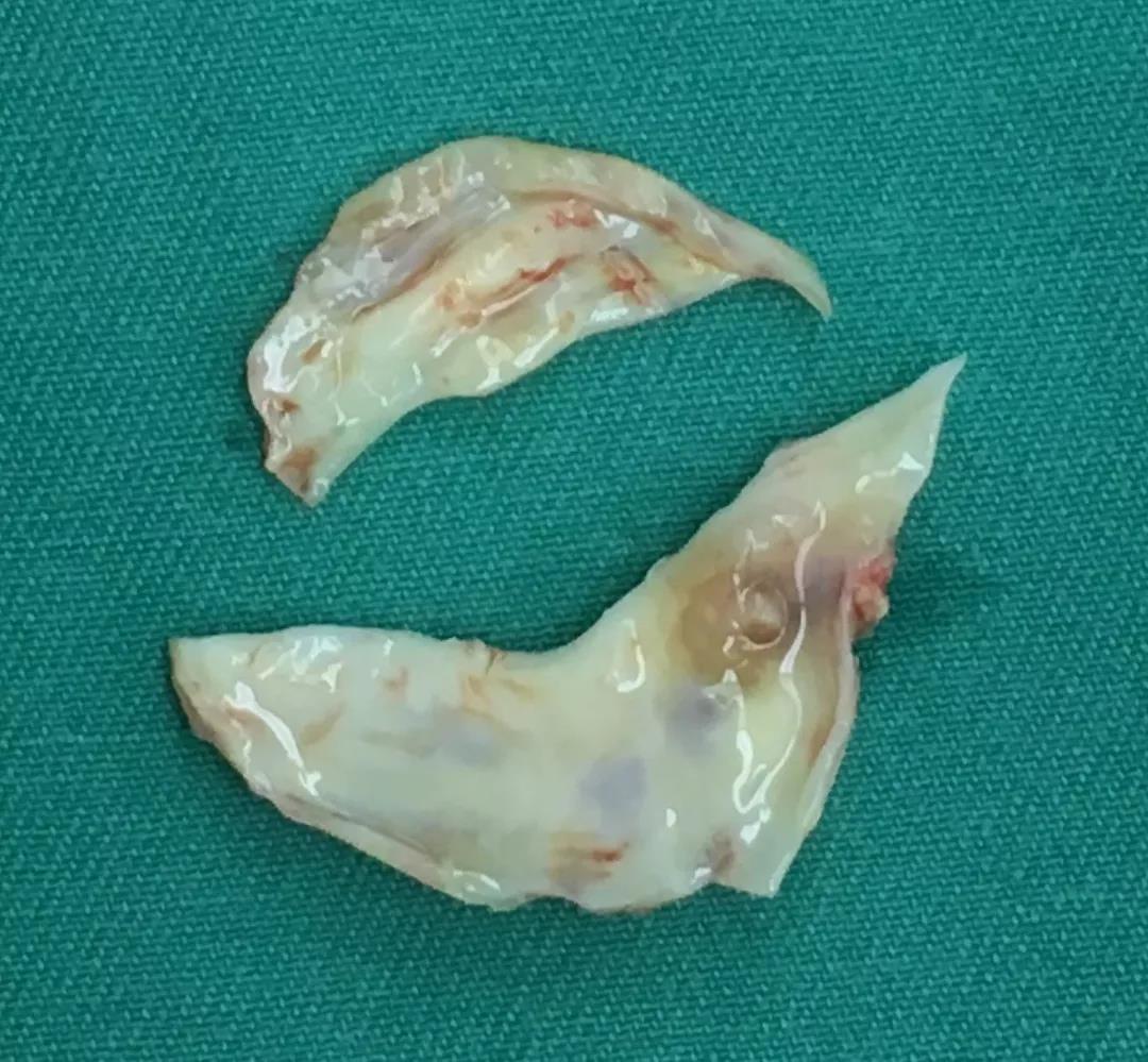 心脏瓣膜病患者必看