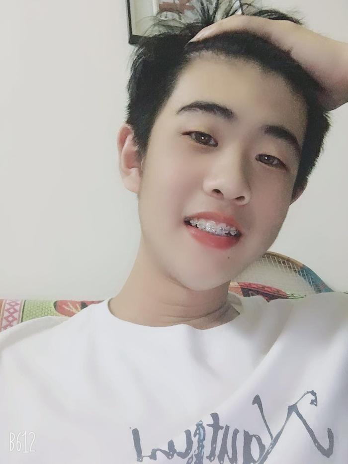 16岁小帅哥牙齿矫正五个月变化分享