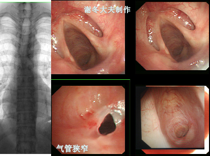 气管狭窄气管插管气管切开后狭窄是什么如何治疗