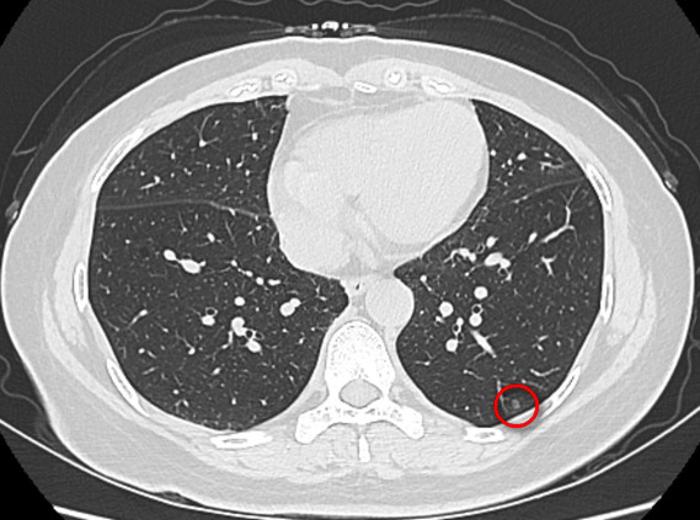 單孔胸腔鏡治療多發肺磨玻璃結節