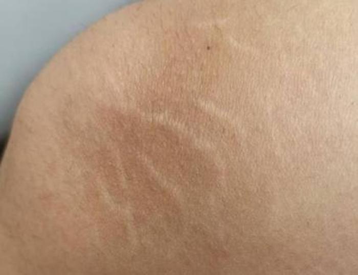 让膨胀纹别再"膨胀",该怎么做?