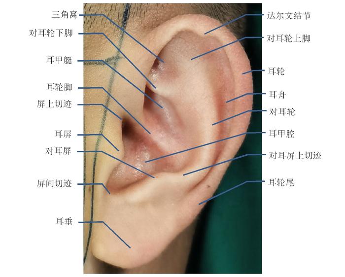 常见先天性耳廓畸形