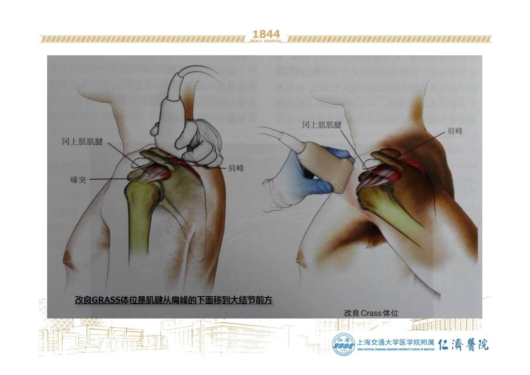 冻结肩病人手臂为什么不能上举