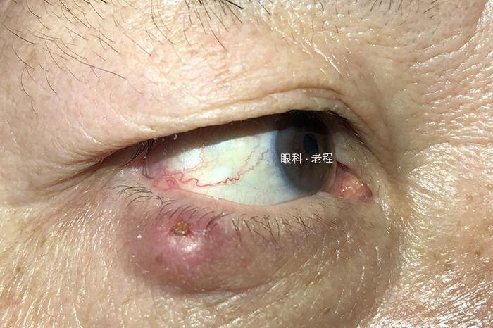 眼皮上长肉球是囊肿还是癌症
