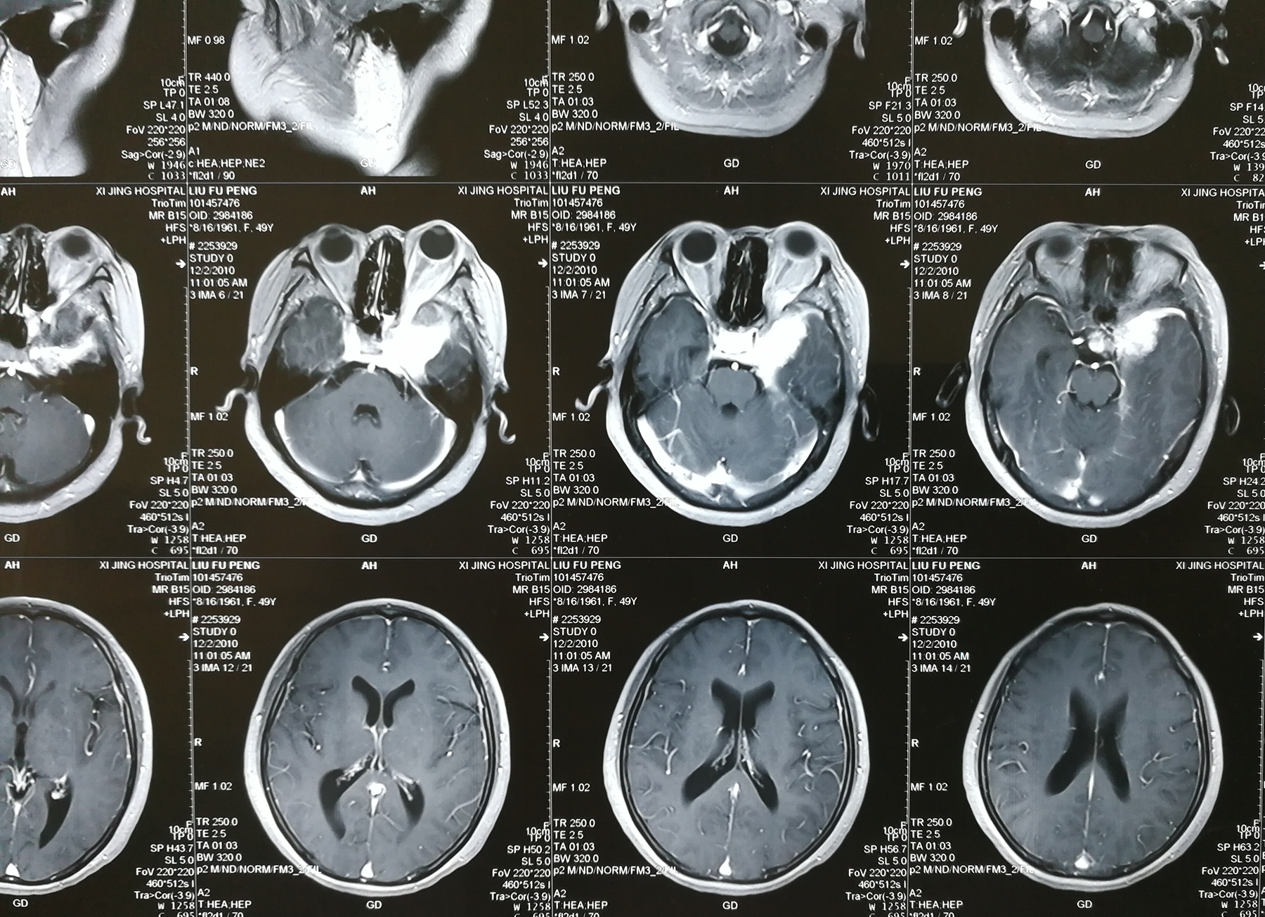 贺晓生教授脑膜瘤治疗案例展示图例
