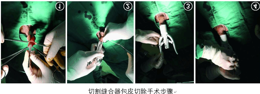 借助器械,而非手工的包皮切除术,主要的方式有卡环(商环)和吻合器(环