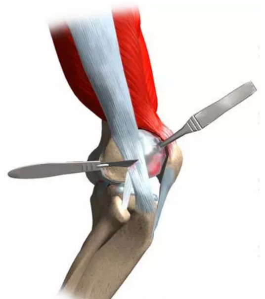 手朮包括:滑囊的移除,松解或延长髂胫束以减轻其对股骨的磨擦.