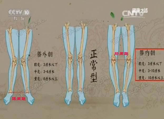 儿童o型腿及x型腿了解儿童膝内翻与膝外翻