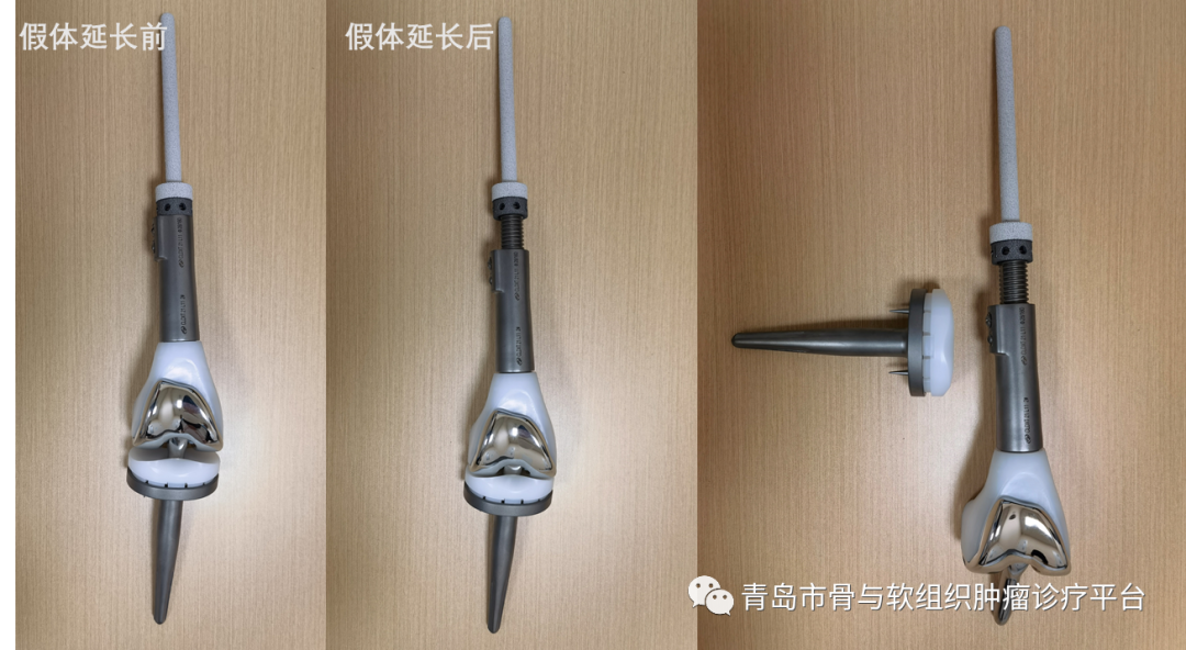典型病例可延长肿瘤型膝关节假体治疗儿童膝关节股骨远端骨肉瘤