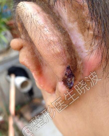 78小耳畸形再造术后耳朵磕碰受伤怎么办晓波医生原创