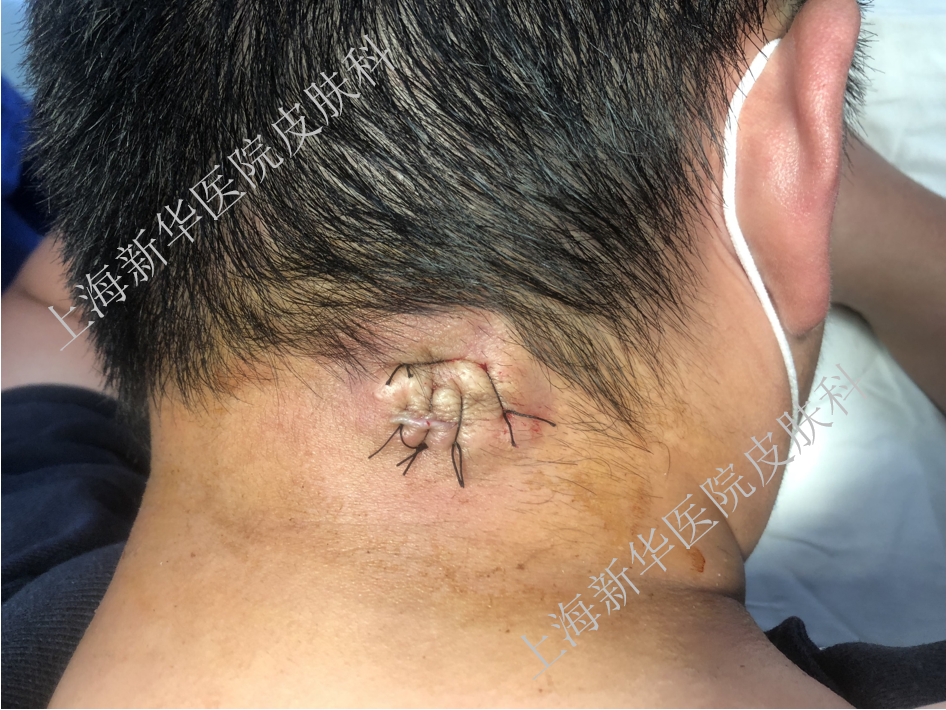 "粉瘤"是什么?该怎么治?总能挤出白色牙膏样东西.