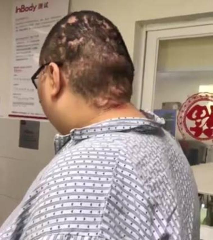 头上长了好几十个包379斤男孩得脱发性毛囊炎密集恐惧症慎入