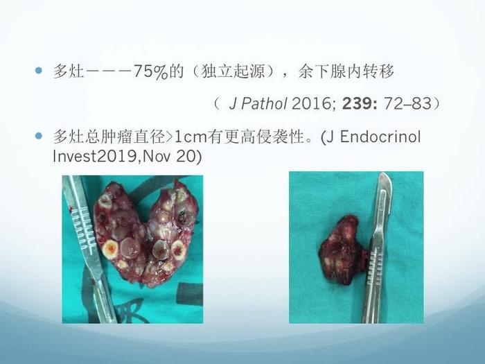 甲状腺微小癌需要个体化处理
