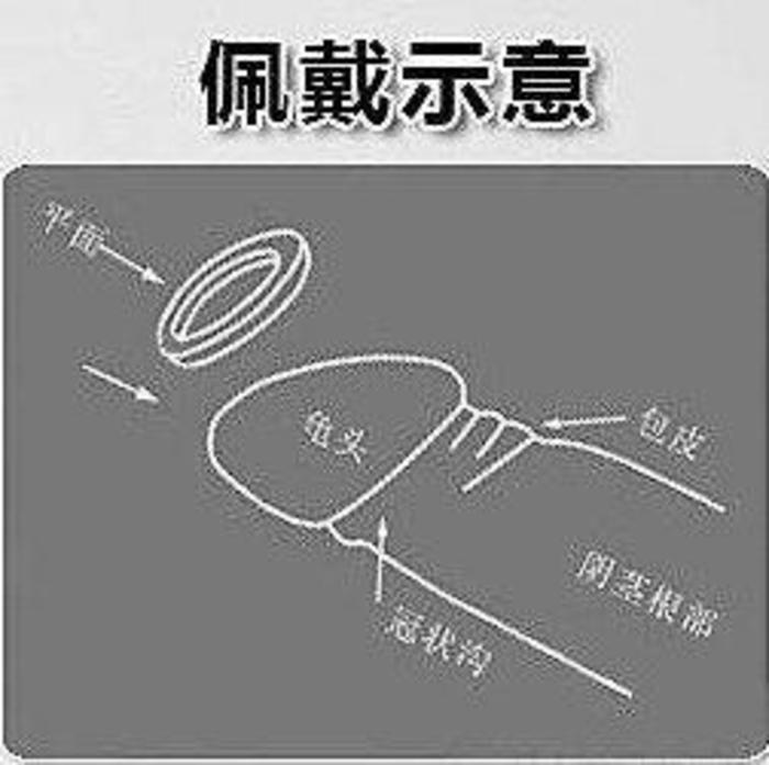 三,包皮阻复环使用疗效包皮阻复环能阻挡包皮的回复,一戴即可达到成功