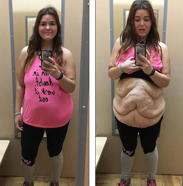 减肥会导致皮肤下垂人显得衰老吗