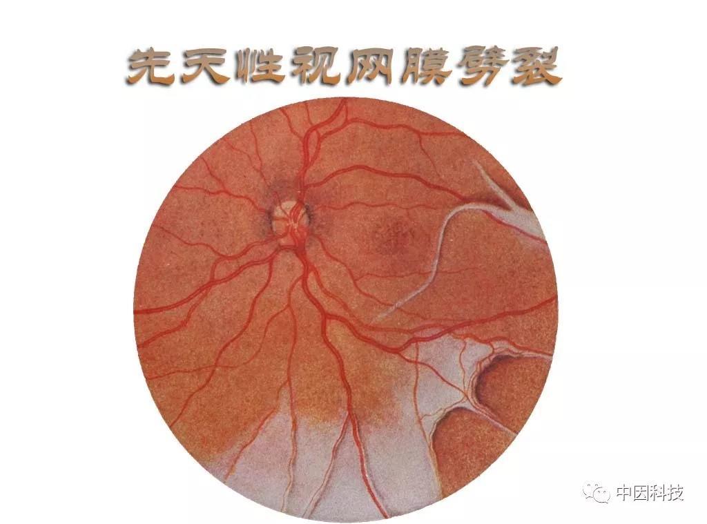 案例分析先天性视网膜劈裂