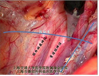 腹股沟疝腹腔镜手术技巧