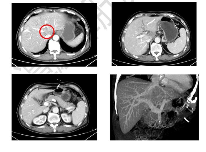 手术根治性切除侵犯下腔静脉的肝门部胆管癌一例分享