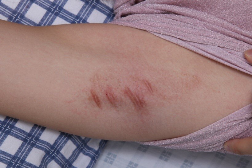 案例一:患者男,41岁,曾行三次手术治疗,腋下留有严重疤痕,但味道依然