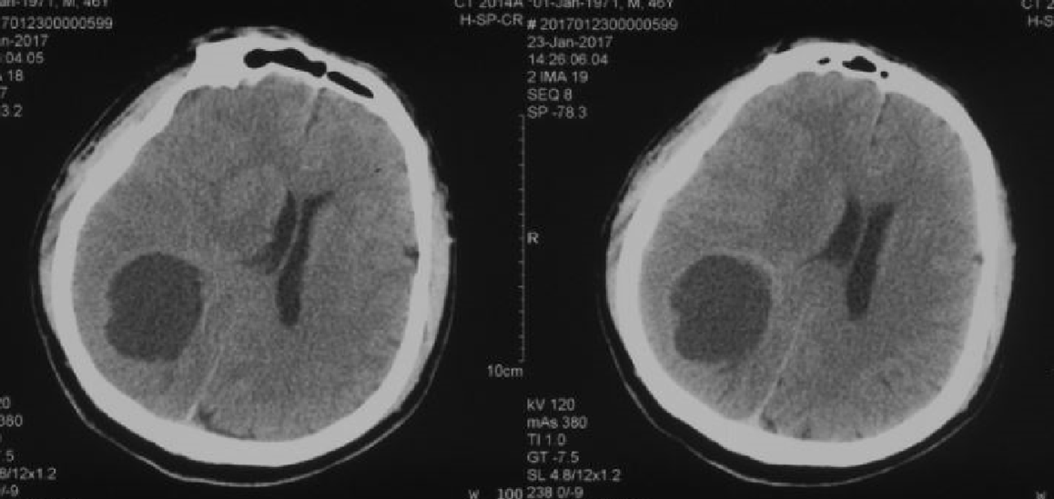 术前头颅ct术前mri术后头颅ct术后病理报告证实为脑胶质瘤.
