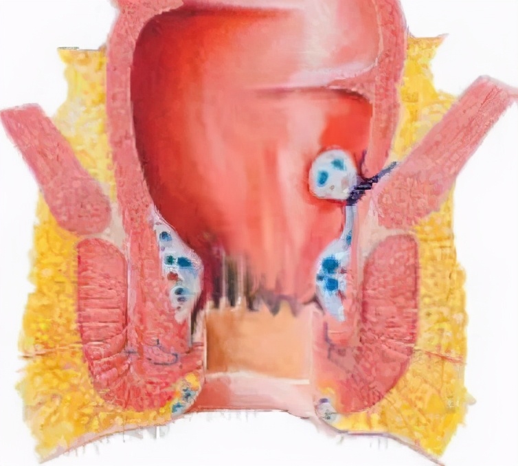 当天可出院的痔疮手术怎么做?