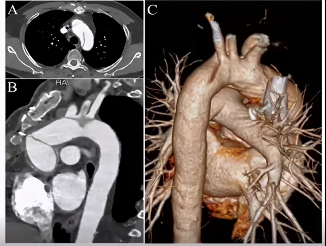 手术史:28年前行"胰腺坏死组织清除术";19年前因"升主动脉瘤 ai(重度)