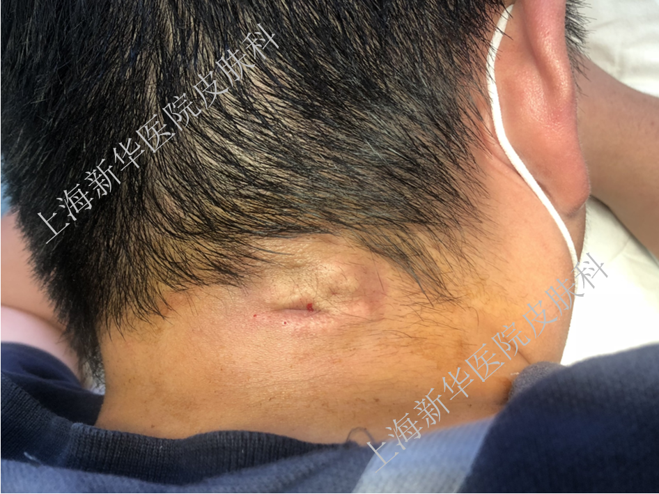 "粉瘤"是什么?该怎么治?总能挤出白色牙膏样东西.