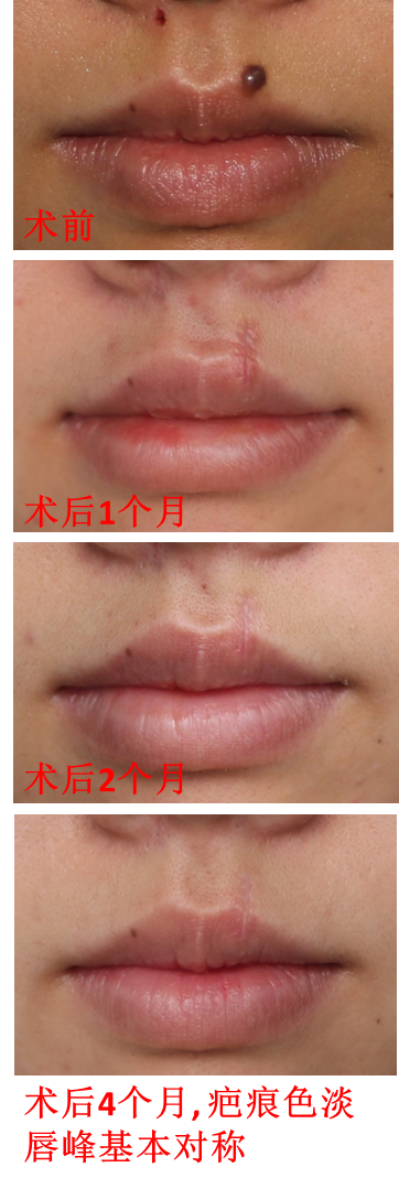 嘴唇黑痣修复重塑美丽的丘比特弓
