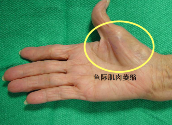 手麻那些事儿(之二)腕管综合征