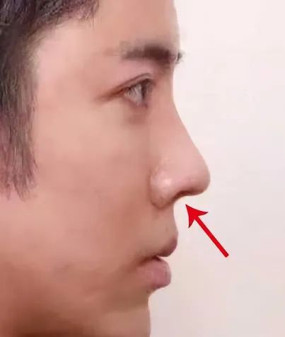 鼻小柱内凹是什么如何改善