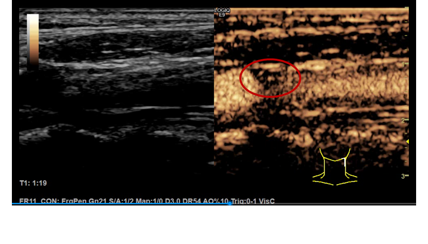 超声检查在评价颈动脉粥样硬化斑块稳定性中的作用 - 微医(挂号网)