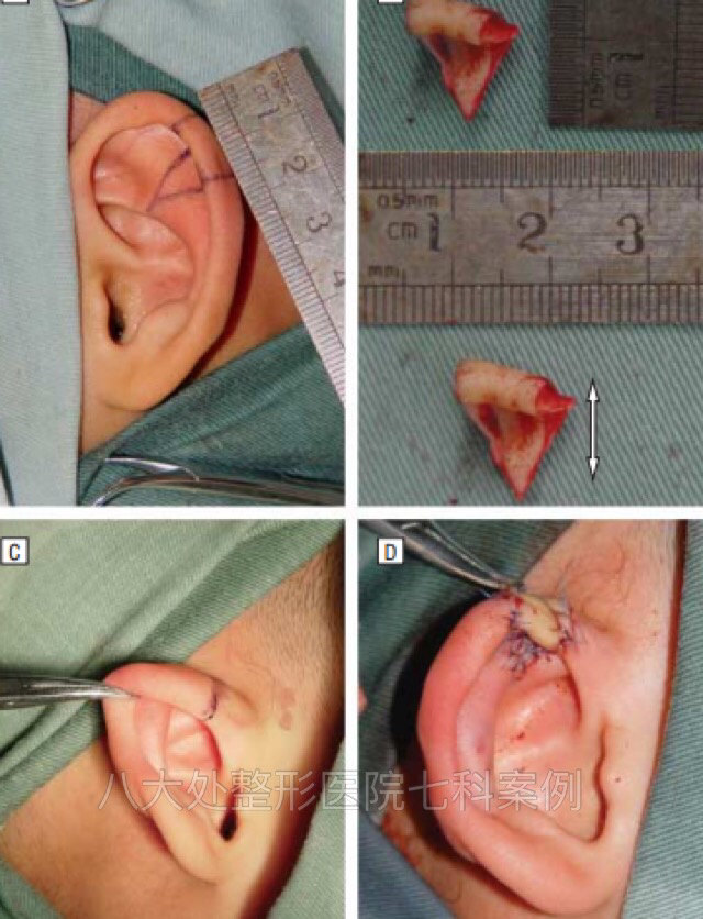 耳畸形杯状耳复合组织移植手术图解八大处于晓波医生