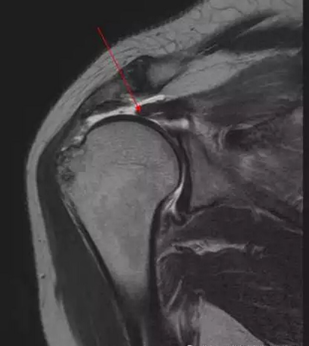 肩关节肌腱病一文读懂肩袖损伤的磁共振分级