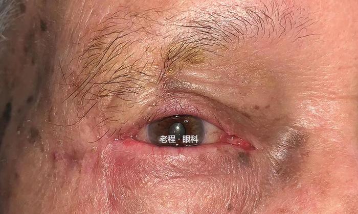 眼睑恶性肿瘤系列之鳞状细胞癌
