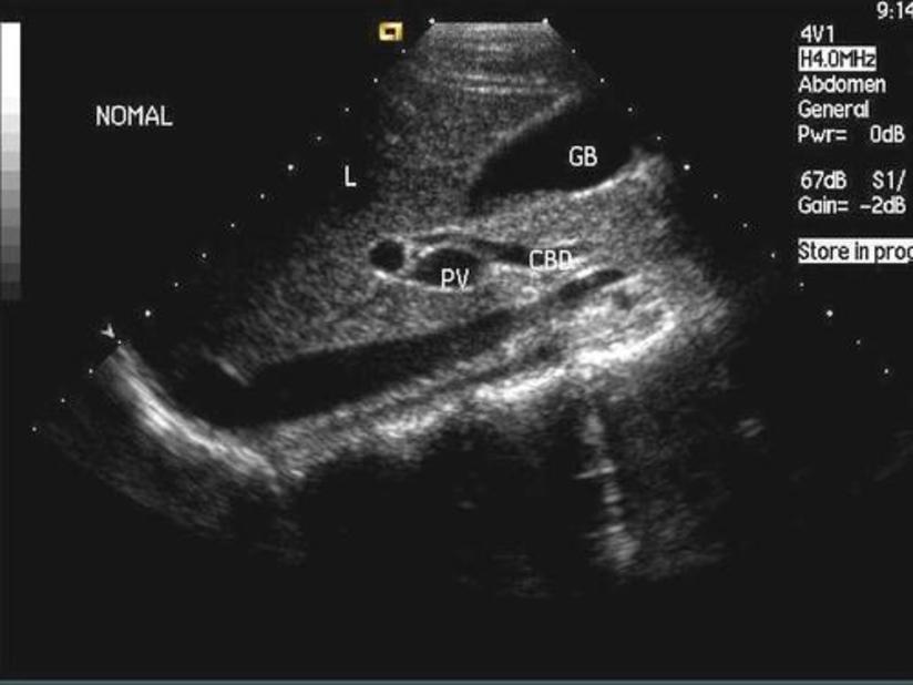 诊断胆囊炎 尤其是萎缩性胆囊炎需谨慎 健康号 微医