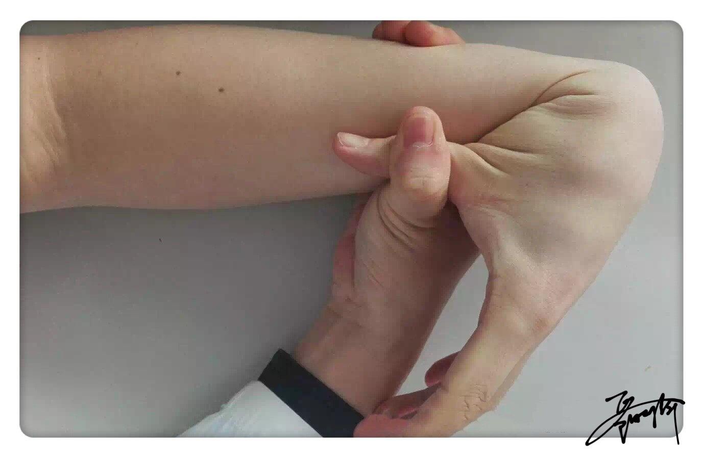 第5指掌指关节被动背伸>90°(左右各1分 图1)一,beighton评分