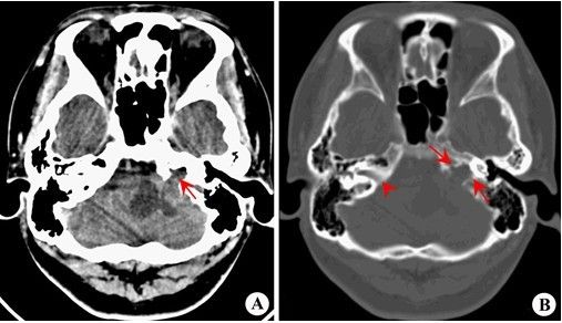 右侧内听道显示正常(↑)mri平扫于左侧桥小脑