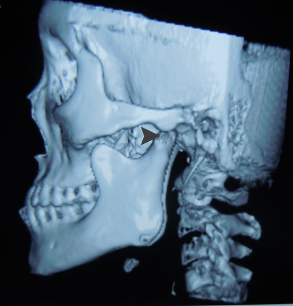 颞下颌关节脱位的治疗选择