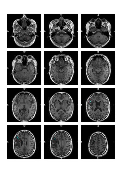 血吸虫病术后,有癫痫反复发作,行脑磁图检查示病灶前方癫痫灶作,作ge